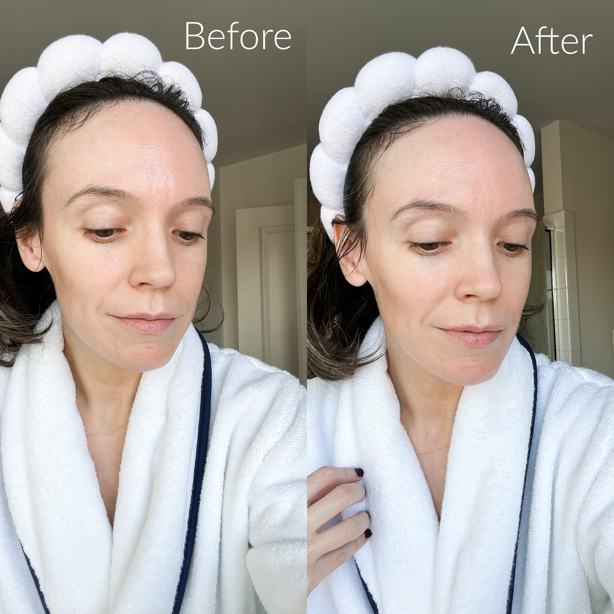 The ordinary hyaluronic acid before and after